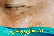 هر آنچه که از لک های پوستی و درمان آن باید بدانید