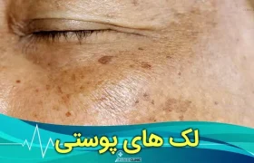 هر آنچه که از لک های پوستی و درمان آن باید بدانید