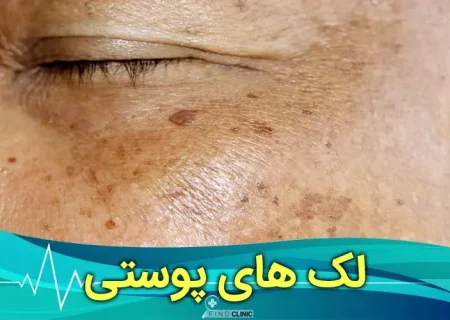 هر آنچه که از لک های پوستی و درمان آن باید بدانید