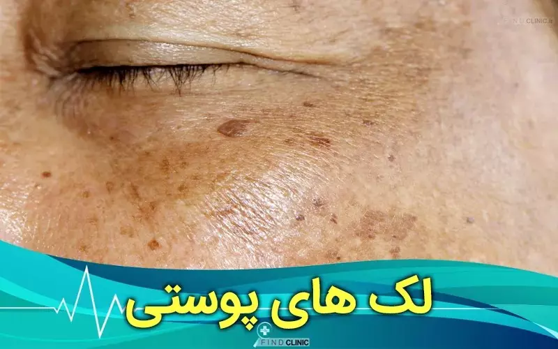 هر آنچه که از لک های پوستی و درمان آن باید بدانید